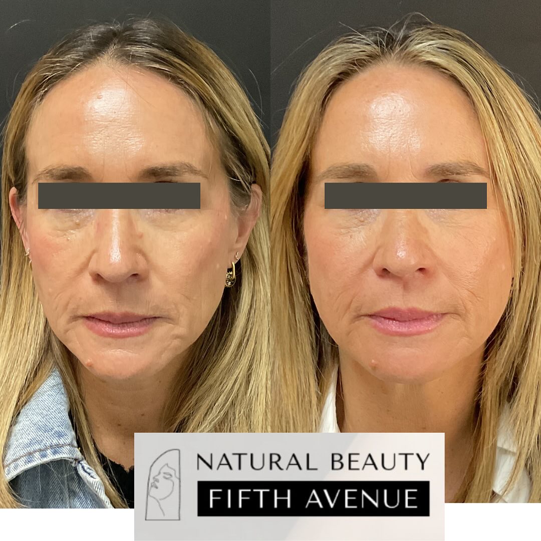 Before and after comparison of patient's forehead and upper face following Sculptra® dermal filler treatment